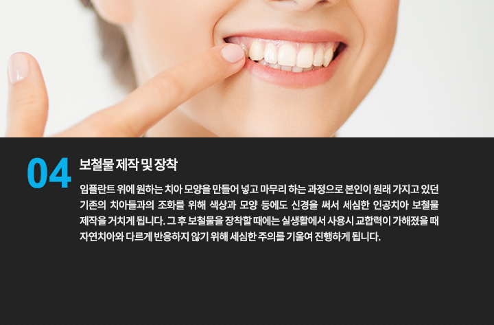 보철물 제작 및 장착
임플란트 위에 원하는 치아 모양을 만들어 넣고 마무리 하는 과정으로 본인이 원래 가지고 있던 기존의 치아들과의 조화를 위해 색상과 모양 등에도 신경을 써서 세심한 인공치아 보철물 제작을 거치게 됩니다. 그 후 보철물을 장착할 때에는 실생활에서 사용시 교합력이 가해졌을 때 자연치아와 다르게 반응하지 않기 위해 세심한 주의를 기울여 진행하게 됩니다.