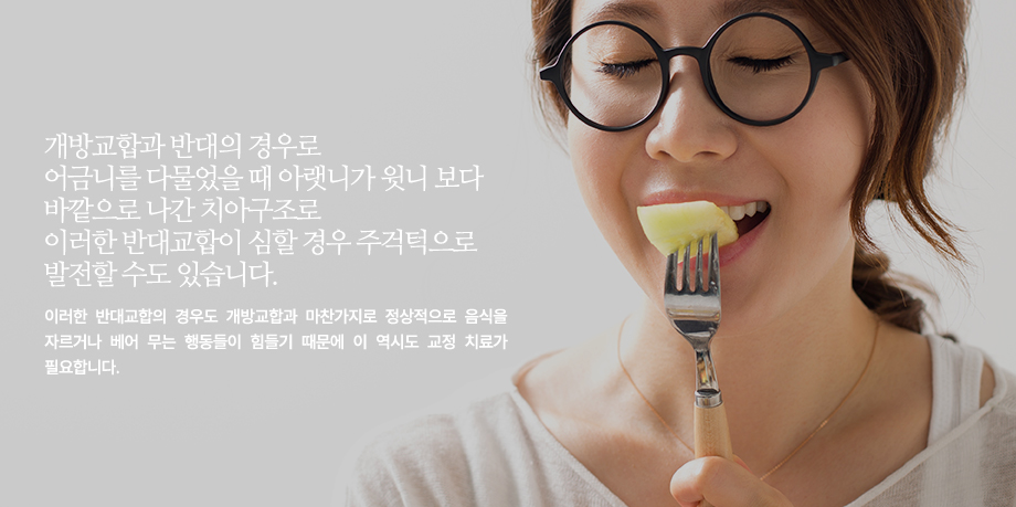 개방교합과 반대의 경우로 어금니를 다물었을 때 아랫니가 윗니 보다 바깥으로 나간 치아구조로 이러한 반대교합이 심할 경우 주걱턱으로 발전할 수도 있습니다. 이러한 반대교합의 경우도 개방교합과 마찬가지로 정상적으로 음식을 자르거나 베어 무는 행동들이 힘들기 때문에 이 역시고 교정 치료가 필요합니다.